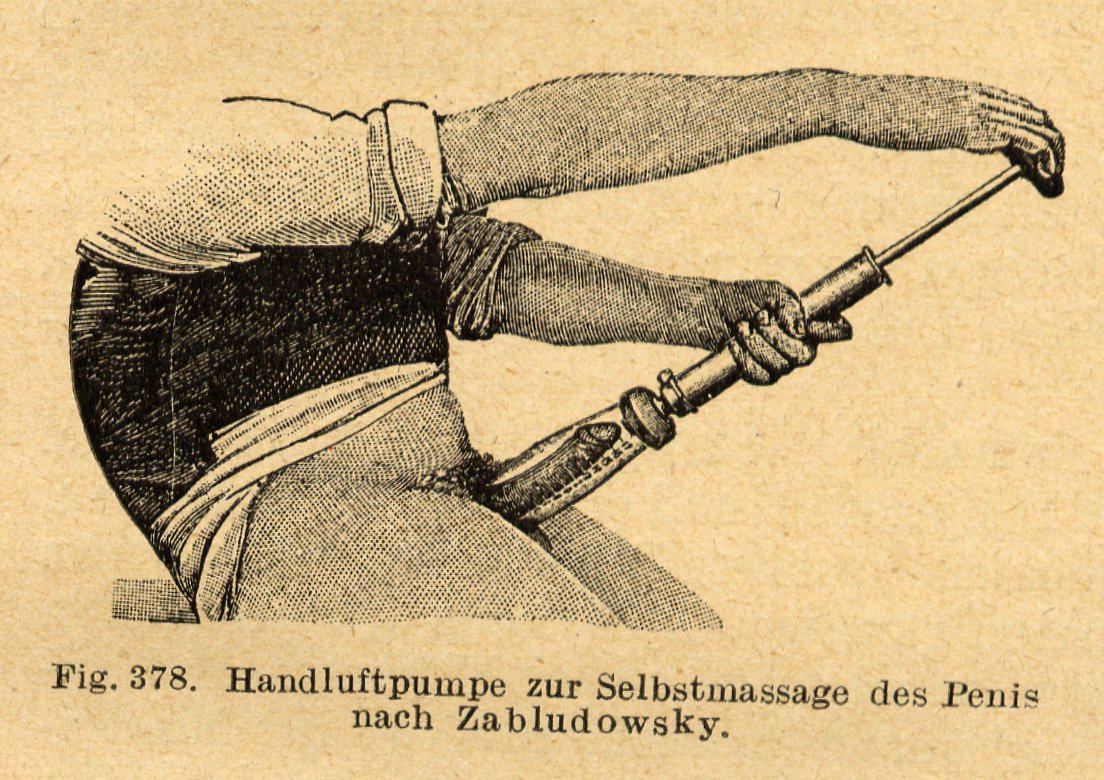 Ilustración histórica de una bomba manual para pene, publicada en un tratado de sexología de 1921
